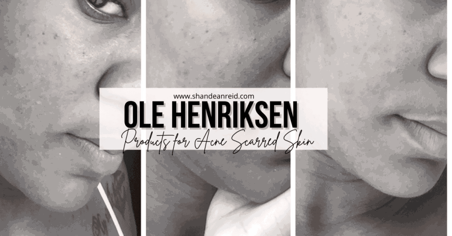 How to Get Rid of Acne With Ole Henriksen Acne Skincare photo 0
